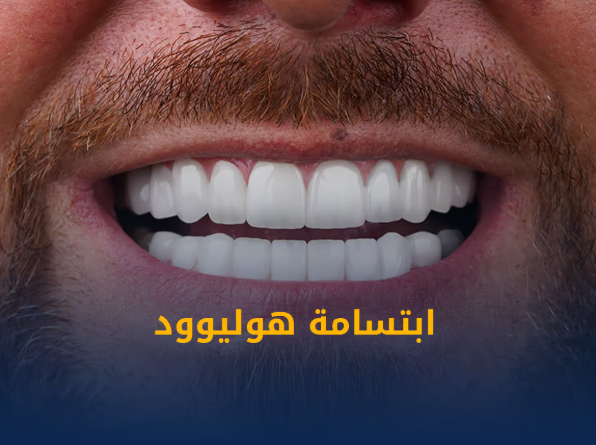 ابتسامة هوليوود