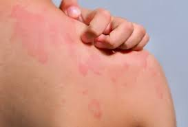 علاج الأمراض الجلدية المزمنة 1 علاج الأمراض الجلدية المزمنة