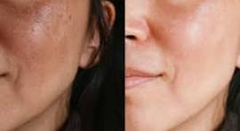 علاج التصبغات والكلف والنمش 2