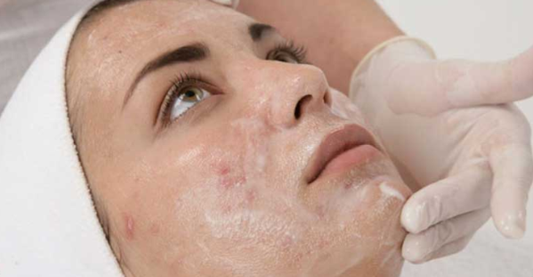 تجديد البشرة بالتقشير الكيميائي