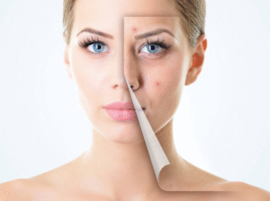 تجديد البشرة بالتقشير الكيميائي