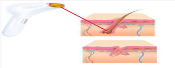 إزالة الشعر بالليزر