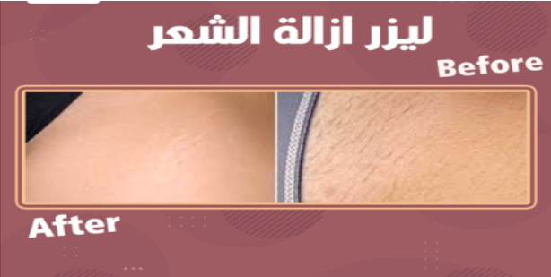 إزالة الشعر بالليزر